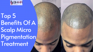 Top 5 Benefits Of A Scalp Micro Pigmentation Treatment